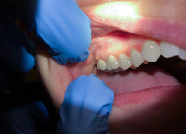 Best Emergency Wisdom Teeth Removal in Roberts, WI