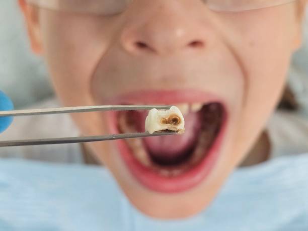 Best Emergency Tooth Extraction in Roberts, WI